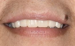 after dental procedure from magnificent mile 2