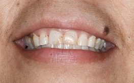 before dental procedure from magnificent mile 2