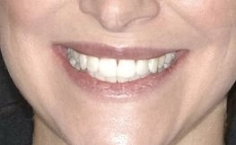 after dental procedure from magnificent mile 3