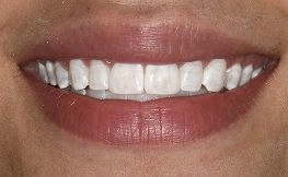 after dental procedure from magnificent mile 1