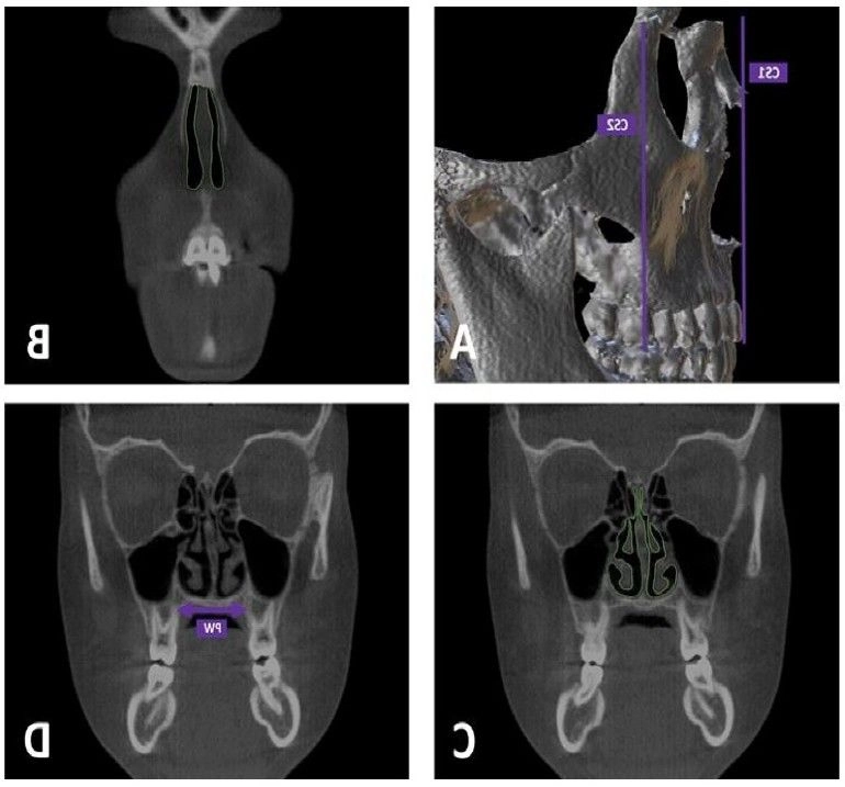patient xrays in relation to dome zero